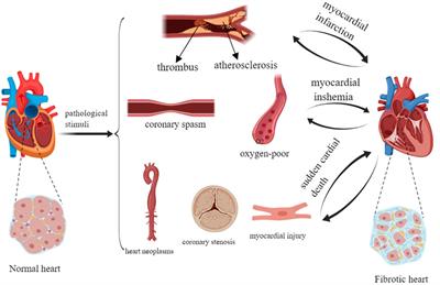 Drugs for treating myocardial fibrosis